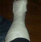 Ayağım alçıya alındı