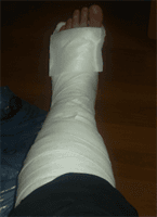 Ayağım alçıya alındı 7 sakatim