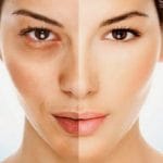 Göz altı morlukları nasıl giderilir ?