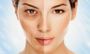 Göz altı morlukları nasıl giderilir ?