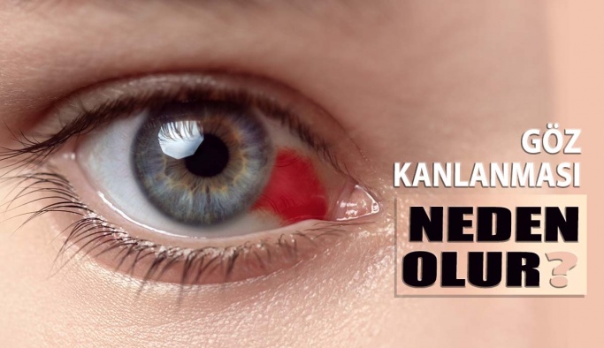 Göz kanlanması neden olur?