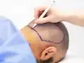 Antalya Saç Ekimi (Hair Transplant Antalya)