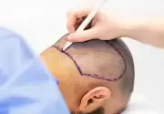 Antalya Saç Ekimi (Hair Transplant Antalya)
