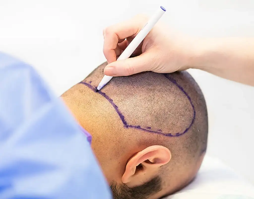 Antalya Saç Ekimi (Hair Transplant Antalya)