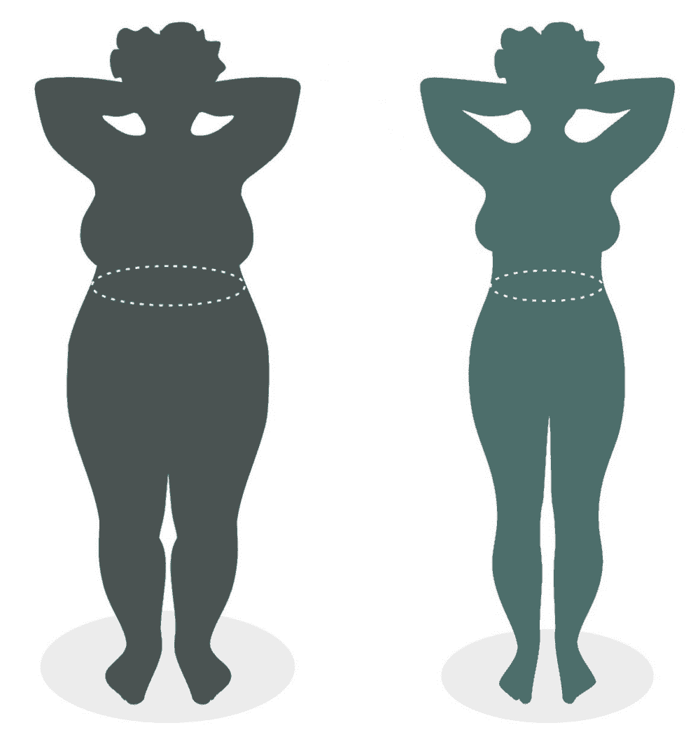 Tüp Mide Ameliyatı Sonrası İyileşme Süreci Nasıl İlerler?