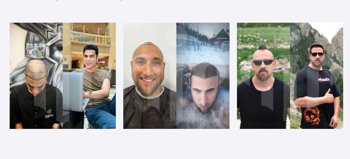 Türkiye Saç Ekimi Fiyatları (Turkey Hair Transplant Cost)