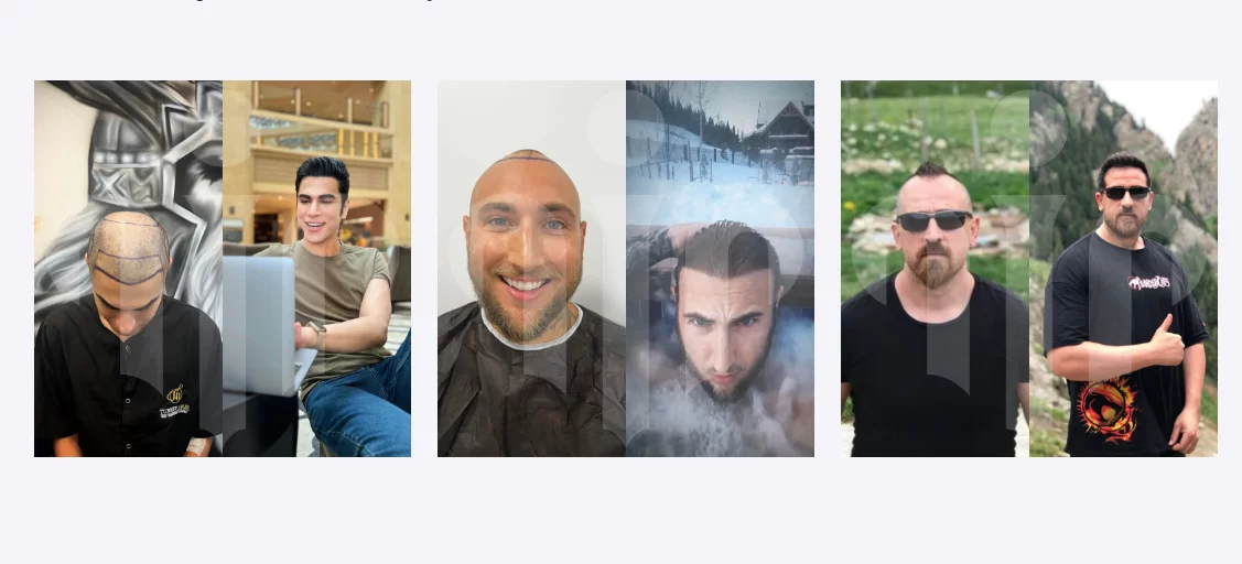 Türkiye Saç Ekimi Fiyatları (Turkey Hair Transplant Cost)