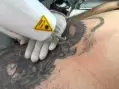 Dövme Nasıl Çıkartılır? Kesin Çözümlerle Acısız Yöntemler
