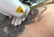 Dövme Nasıl Çıkartılır? Kesin Çözümlerle Acısız Yöntemler