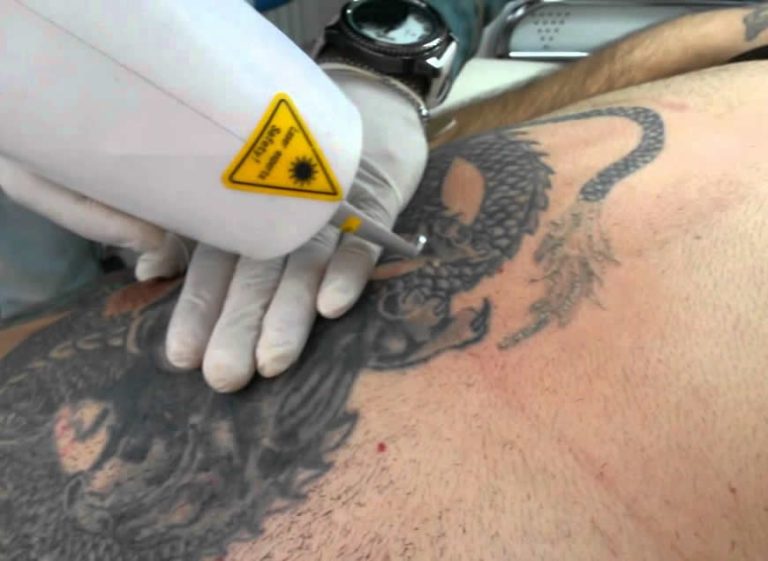 dövme nasıl çıkartılır