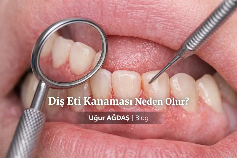 Diş Eti Kanaması Neden Olur?